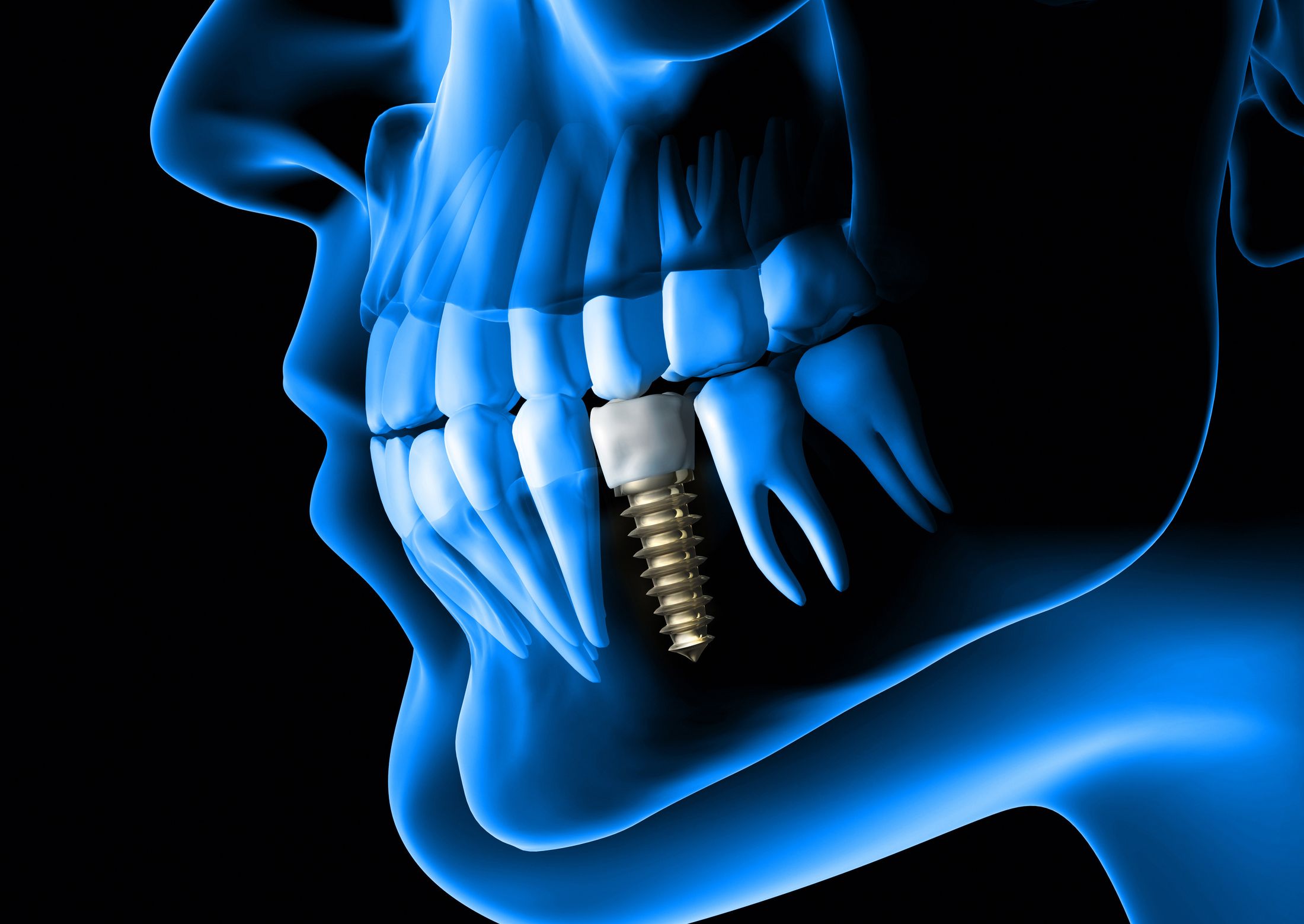 An X-ray style image of a jaw with a dental implant